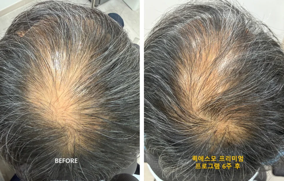 탈모 치료 전후 정수리 사진: BEFORE와 퀵에스모 프리미엄 프로그램 6주 후